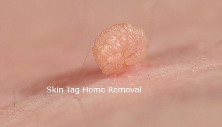 skin tags remover