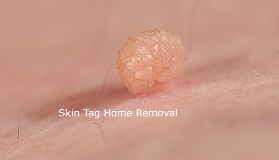 Skin Tags : Causes, Removal, and Home Remedies